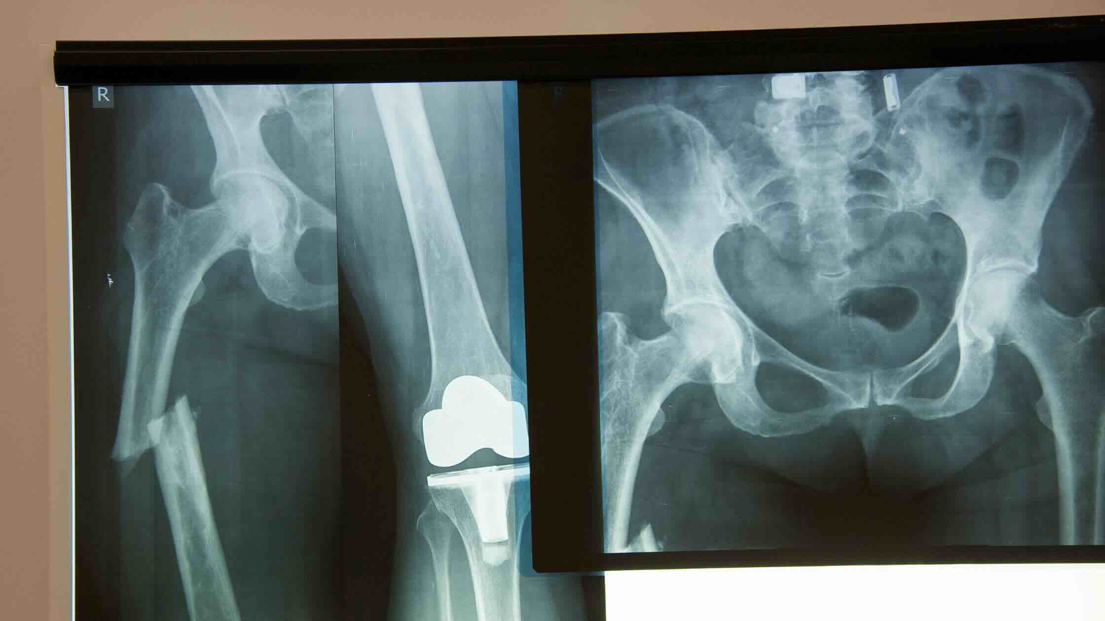Hip fracture on Xray